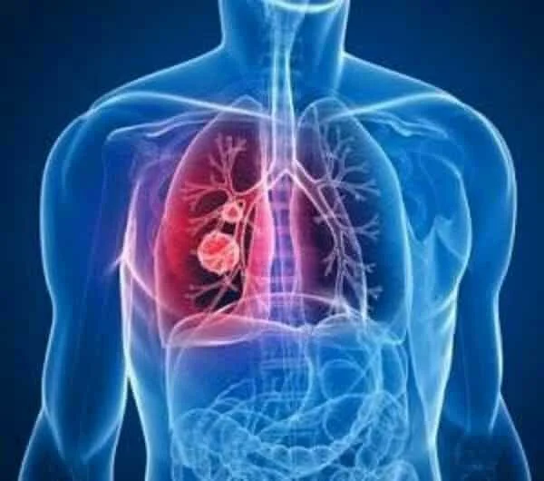 PNEUMONIE